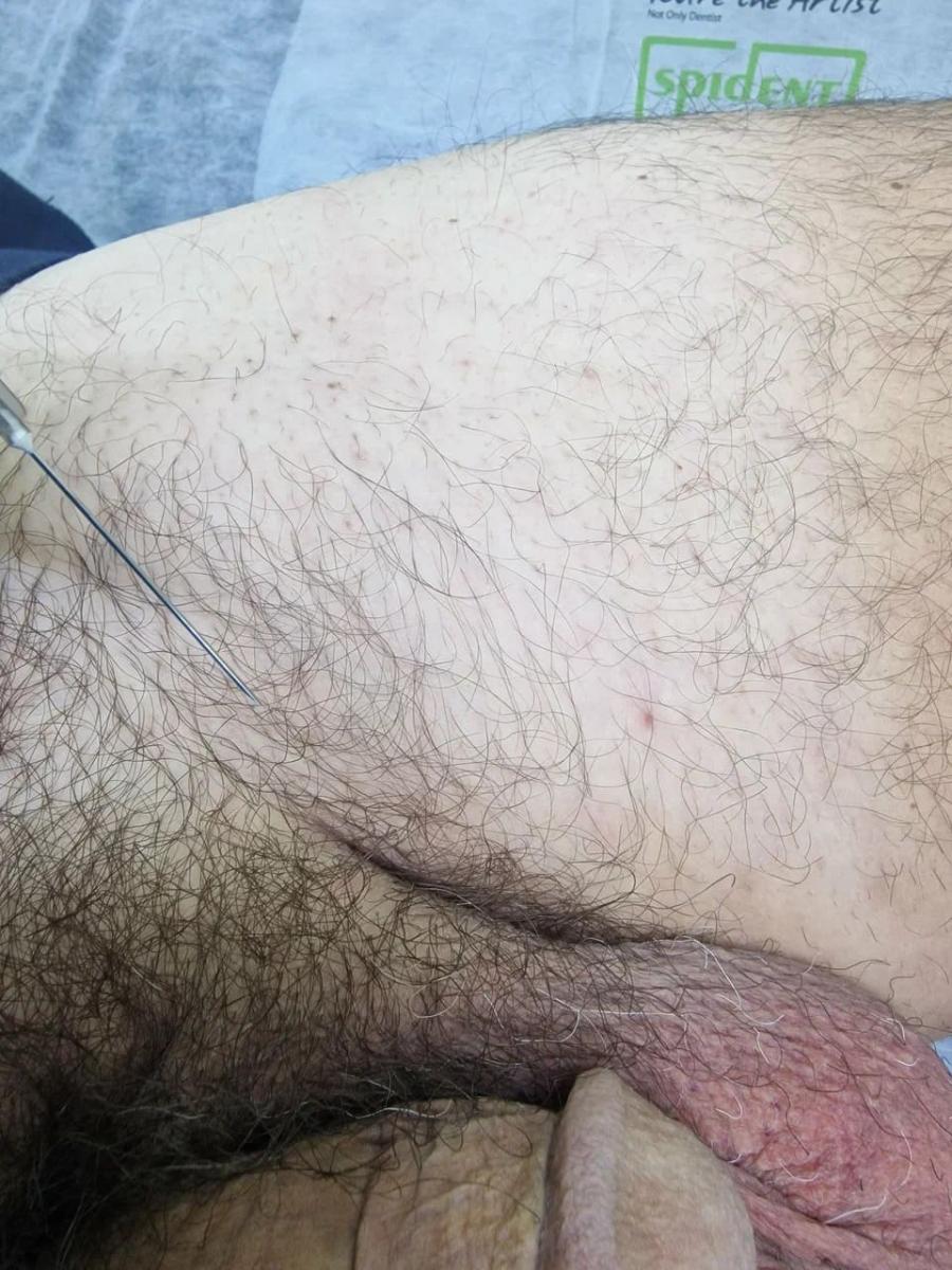 Лимфотропное введение