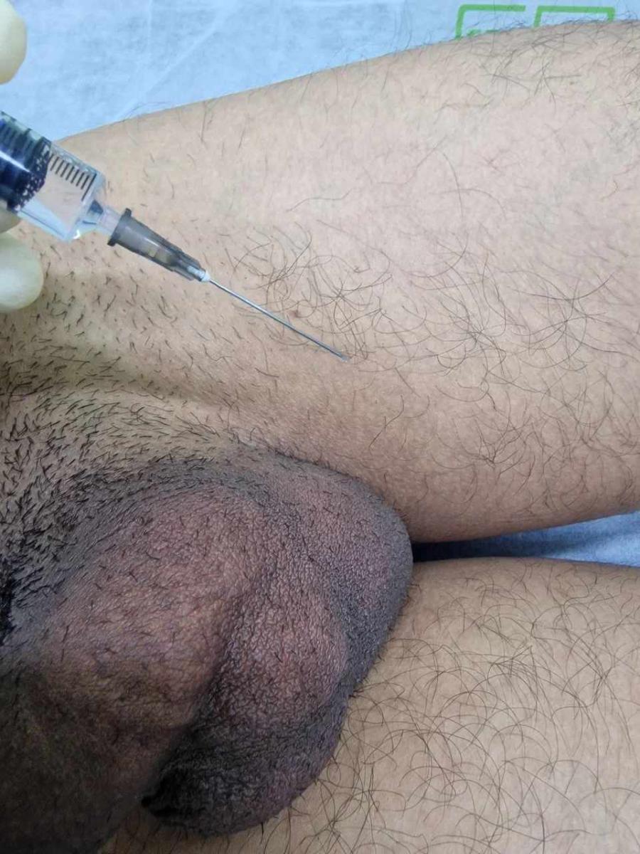 Лимфотропное введение Лимфотропное введение в шею