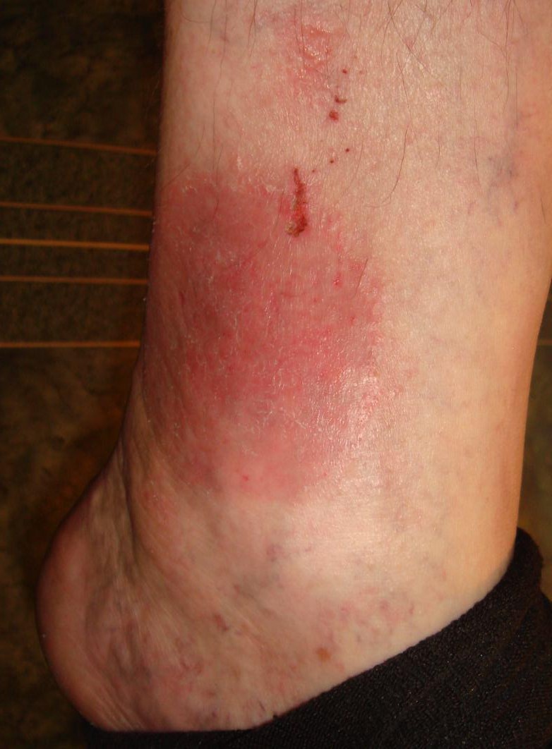 артрит – осложнение уреаплазмоза