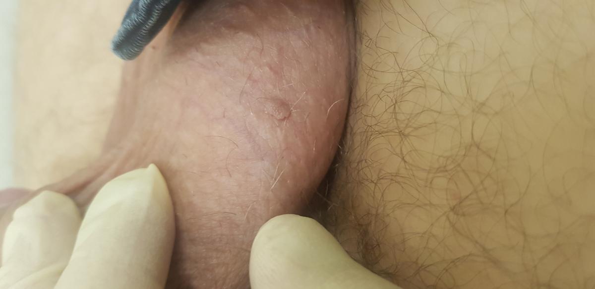 8 типов ВПЧ при кондиломах впч2