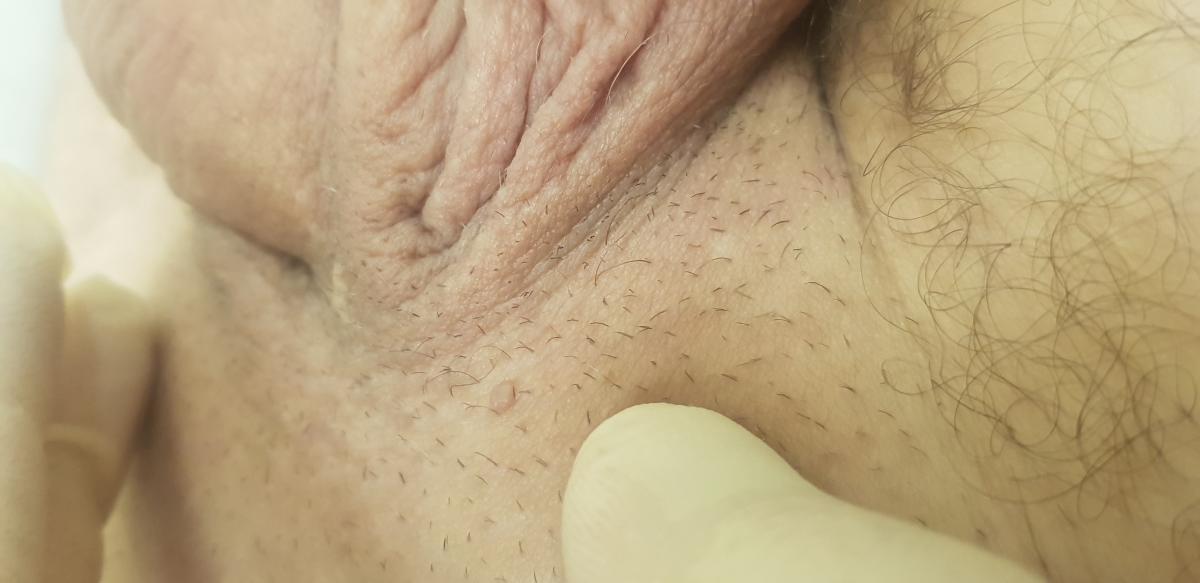 8 типов ВПЧ при кондиломах у мужчины впч4