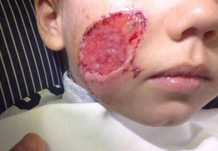 Врожденный сифилис