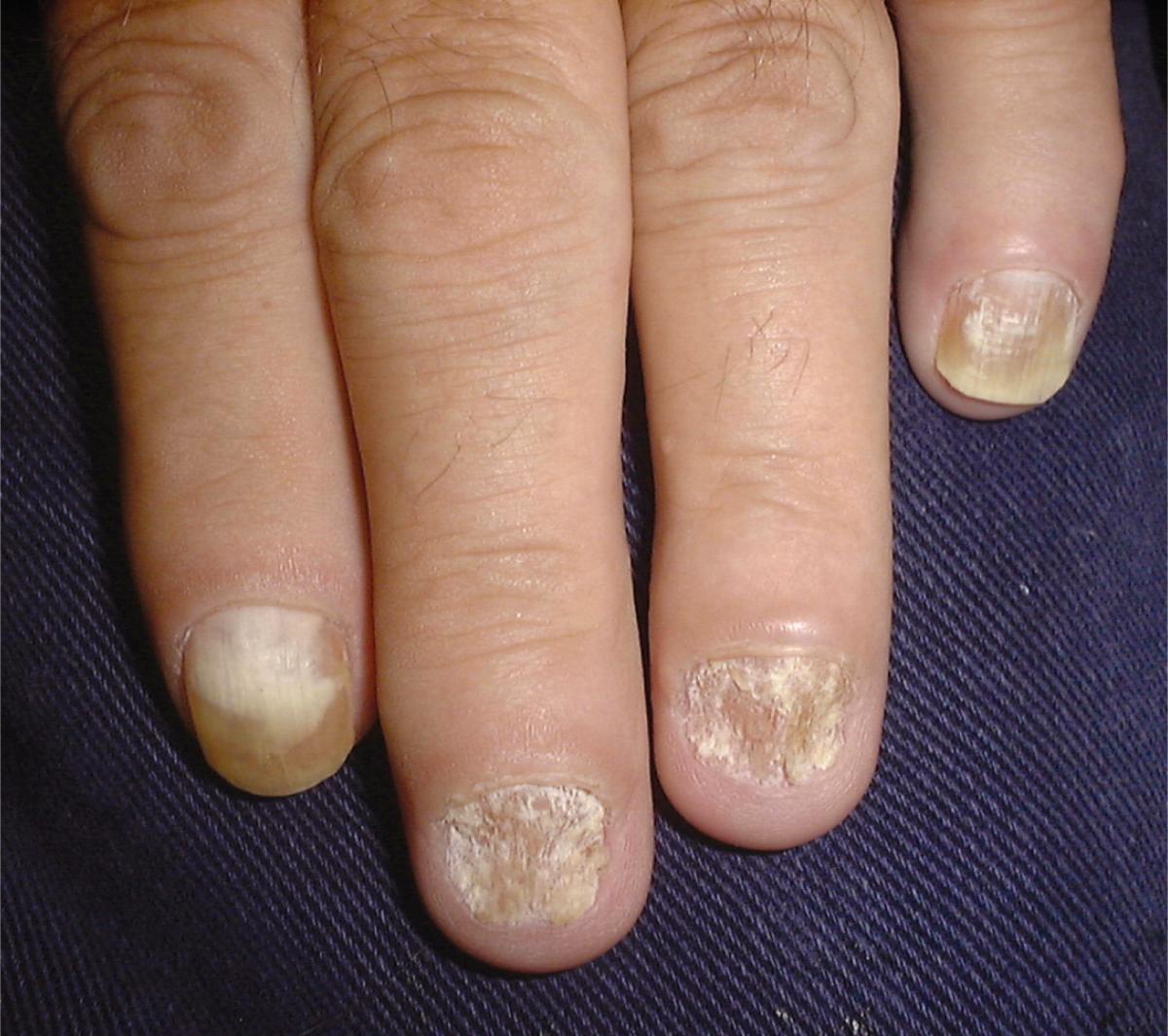 грибковое поражение ногтей кистей