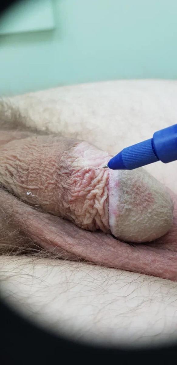 Аппарат и методика холодной плазмы