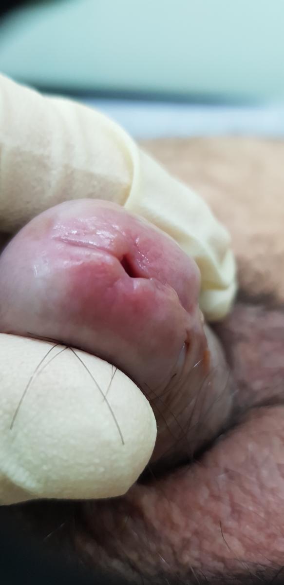 воспаление