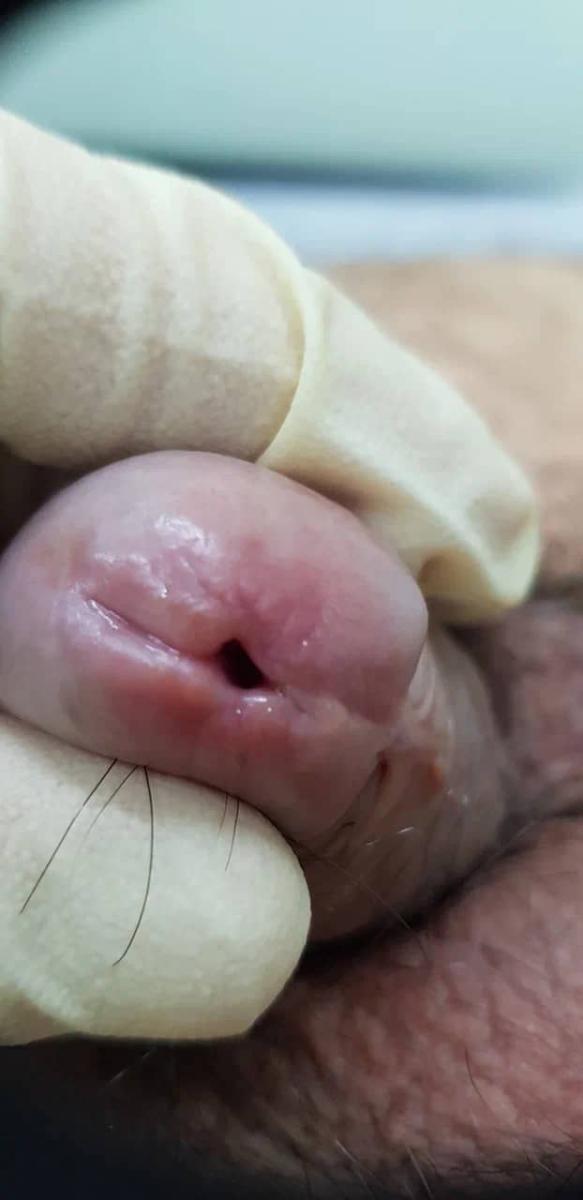 хронический уретрит