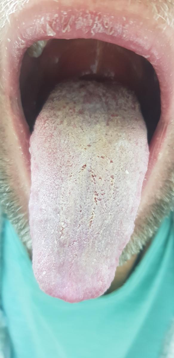 признаки ЗППП кислый привкус