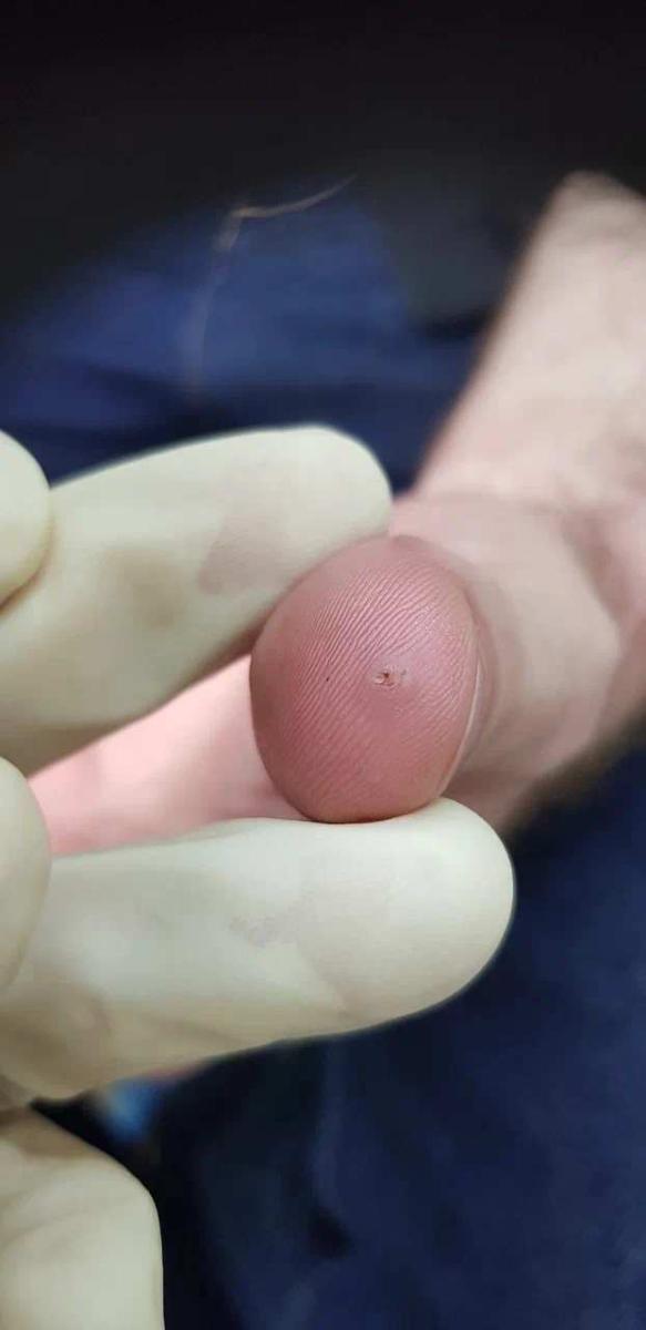 радиоволновое удаление бородавок