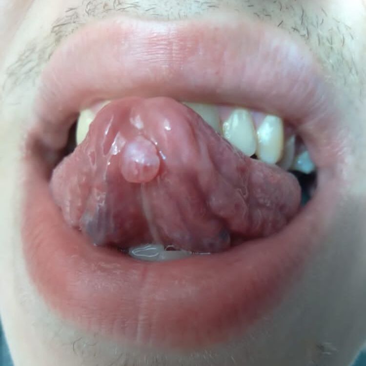 бородавка на языке