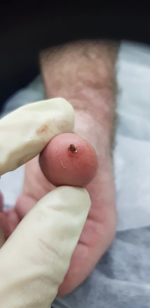 радиоволновое удаление бородавок