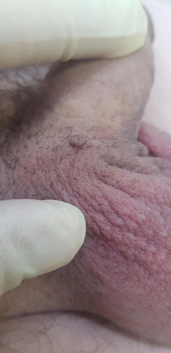 удаление кондилом Вирусы папилломы человека