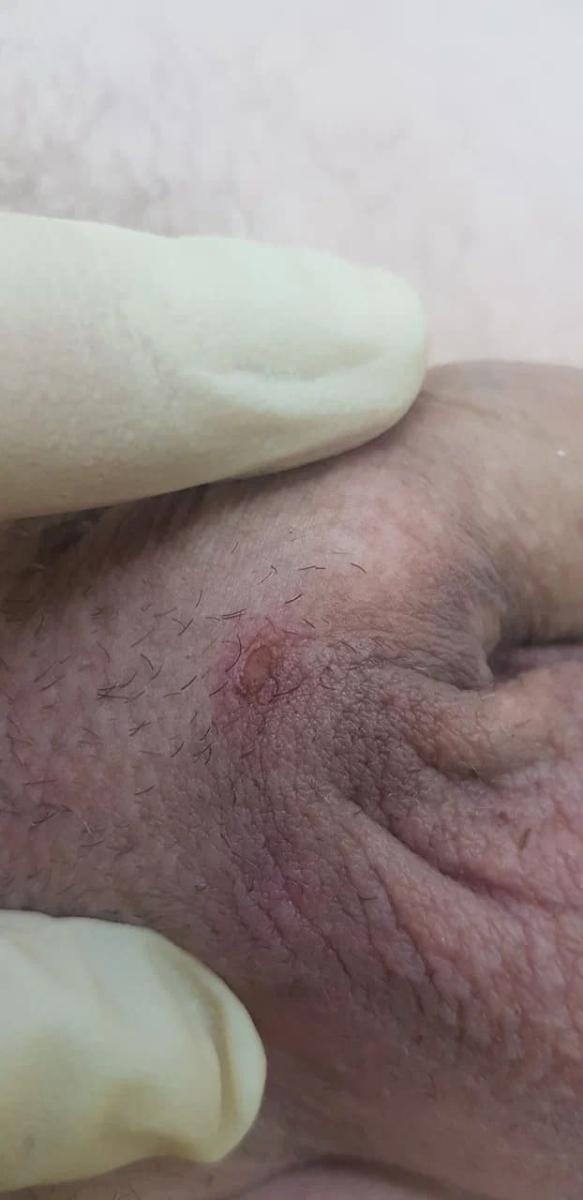 удаление кондилом впч