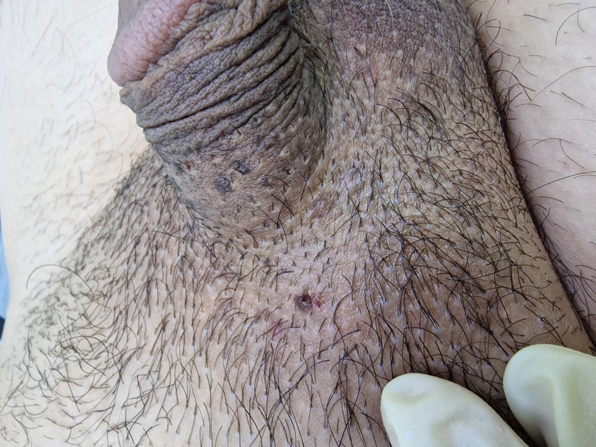 электрокоагулятор электрокоагулятор