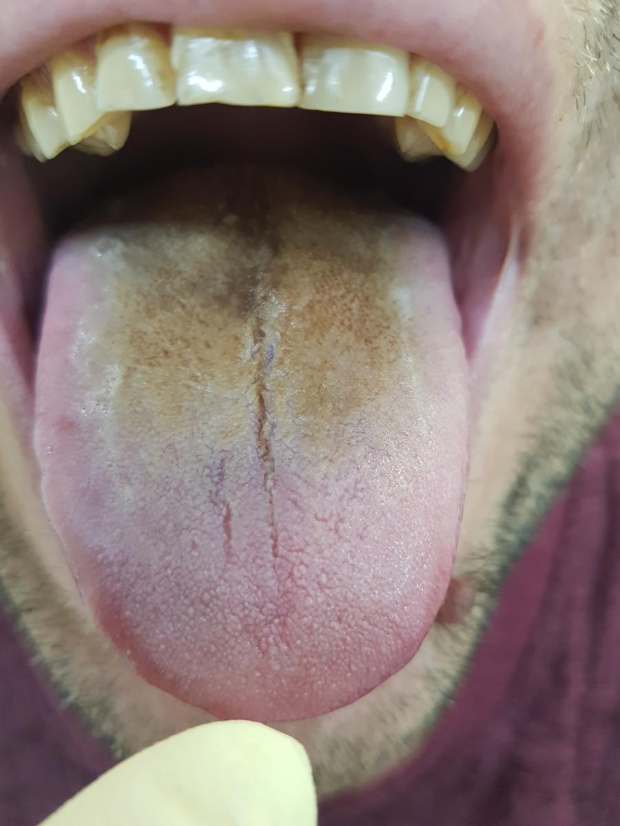 Почернение языка