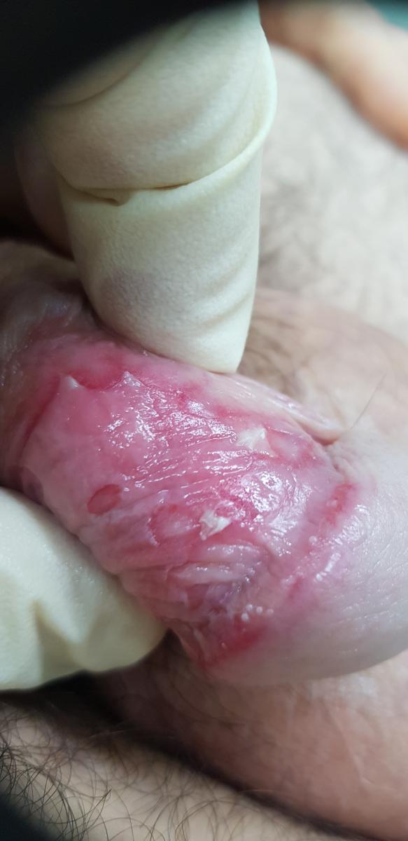 Кандидоз и опрелость на члене