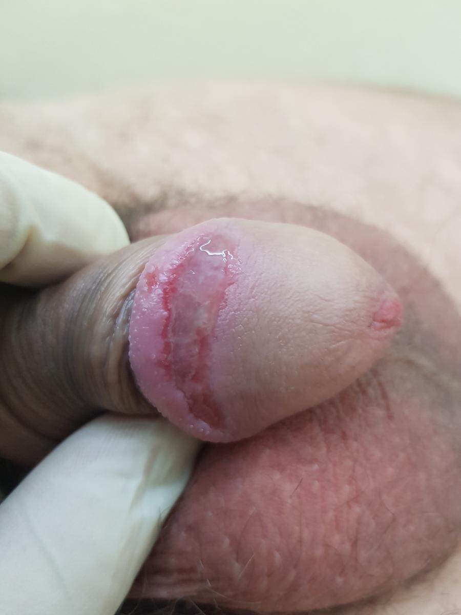 Опрелость и кандидоз на головке члена