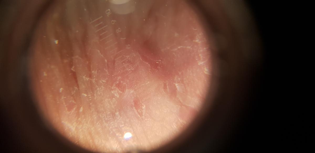 дерматоскопия дерматоскоп