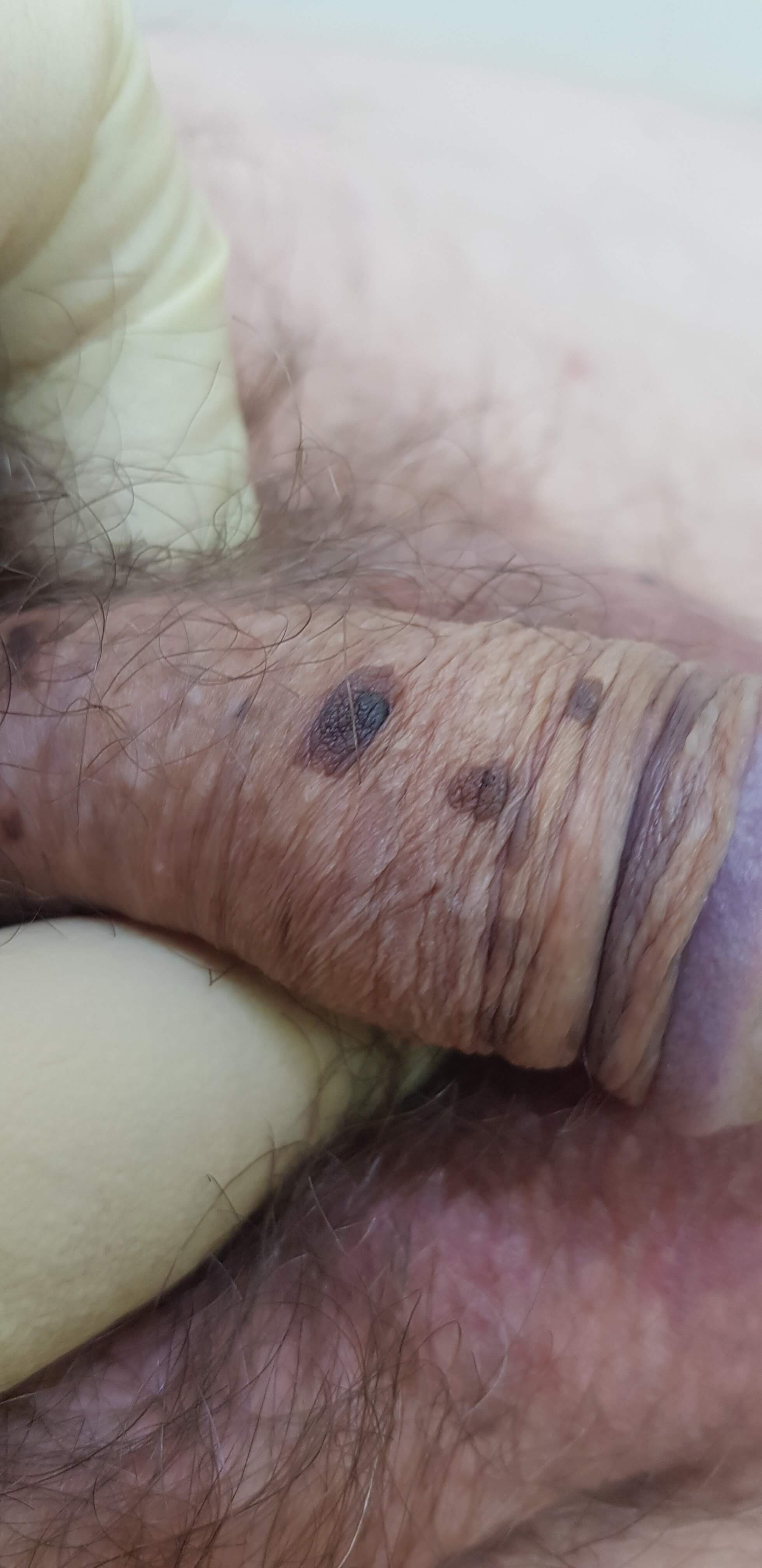 экзофитная форма