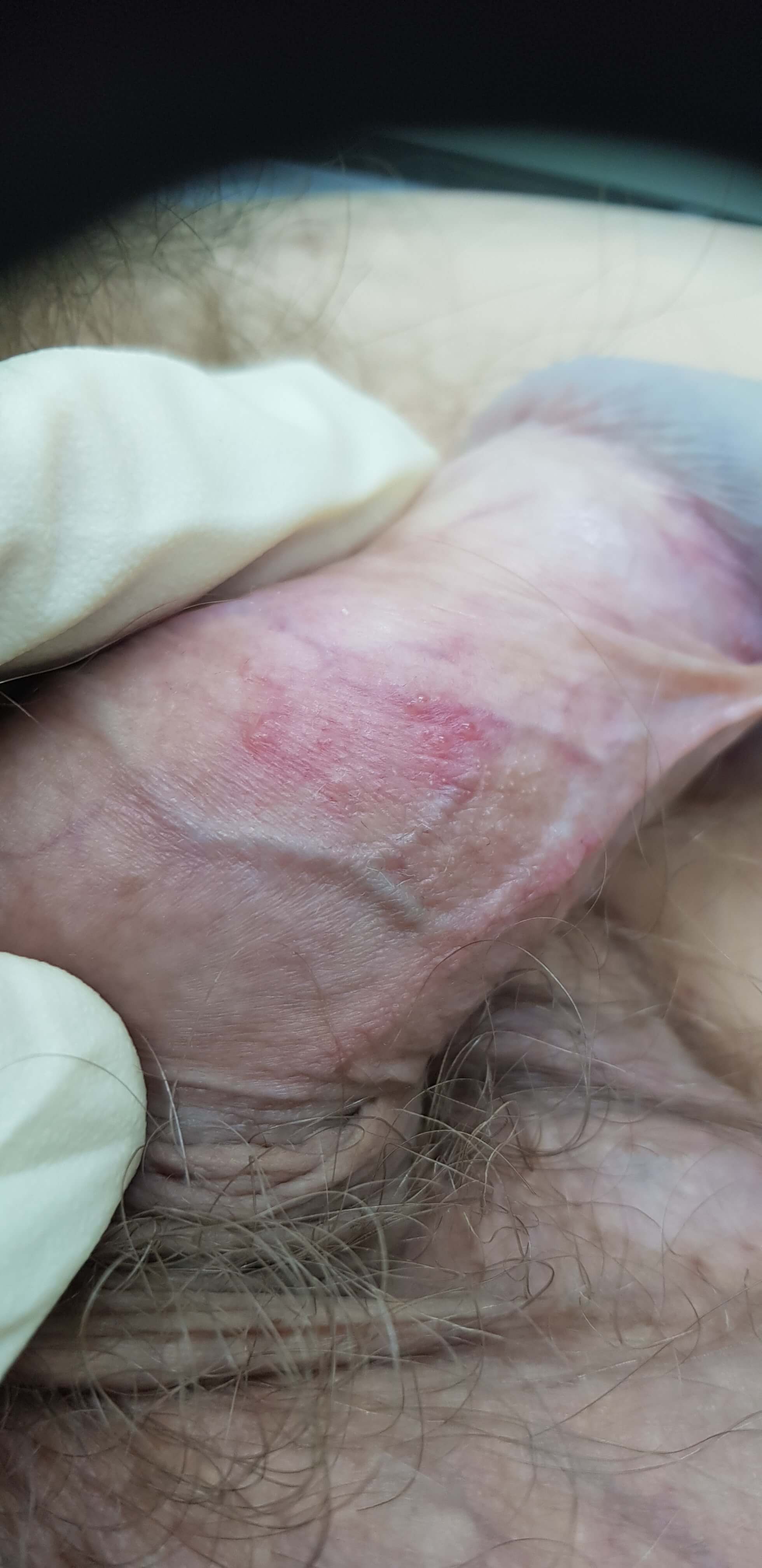 генитальный герпес