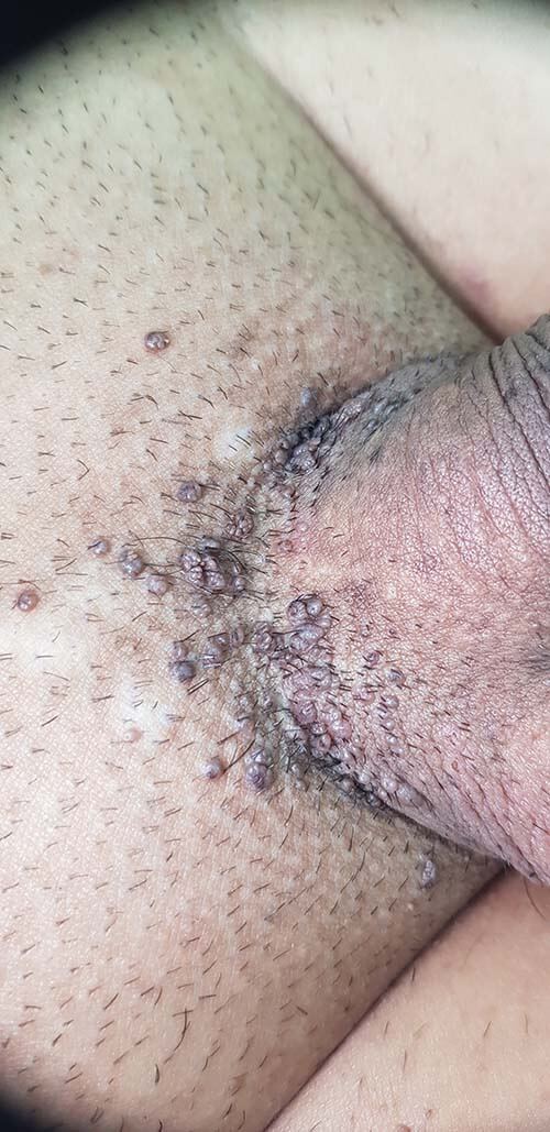 кондиломы на пенисе проявления ВПЧ у мужчин