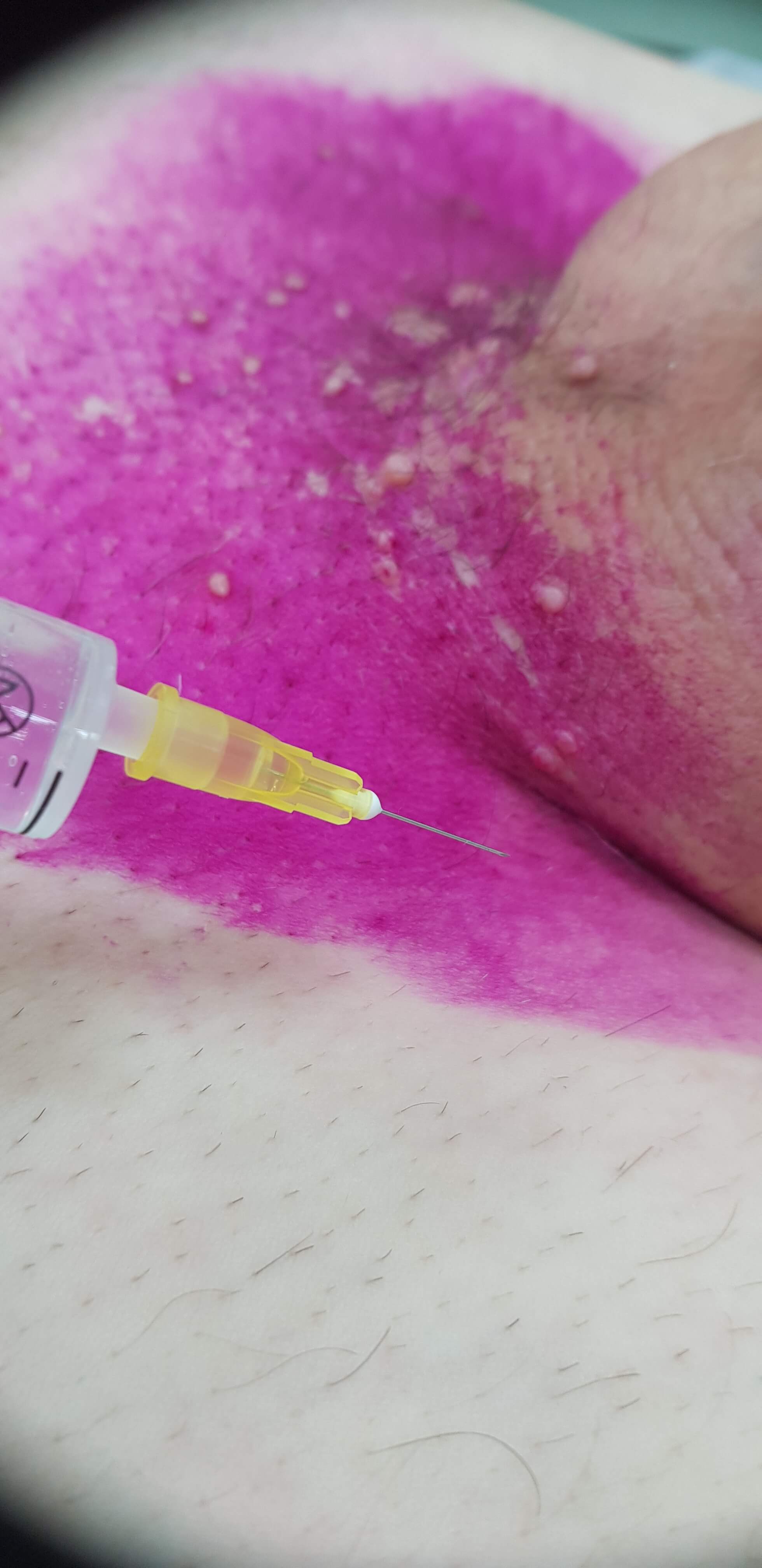 антитела сифилиса