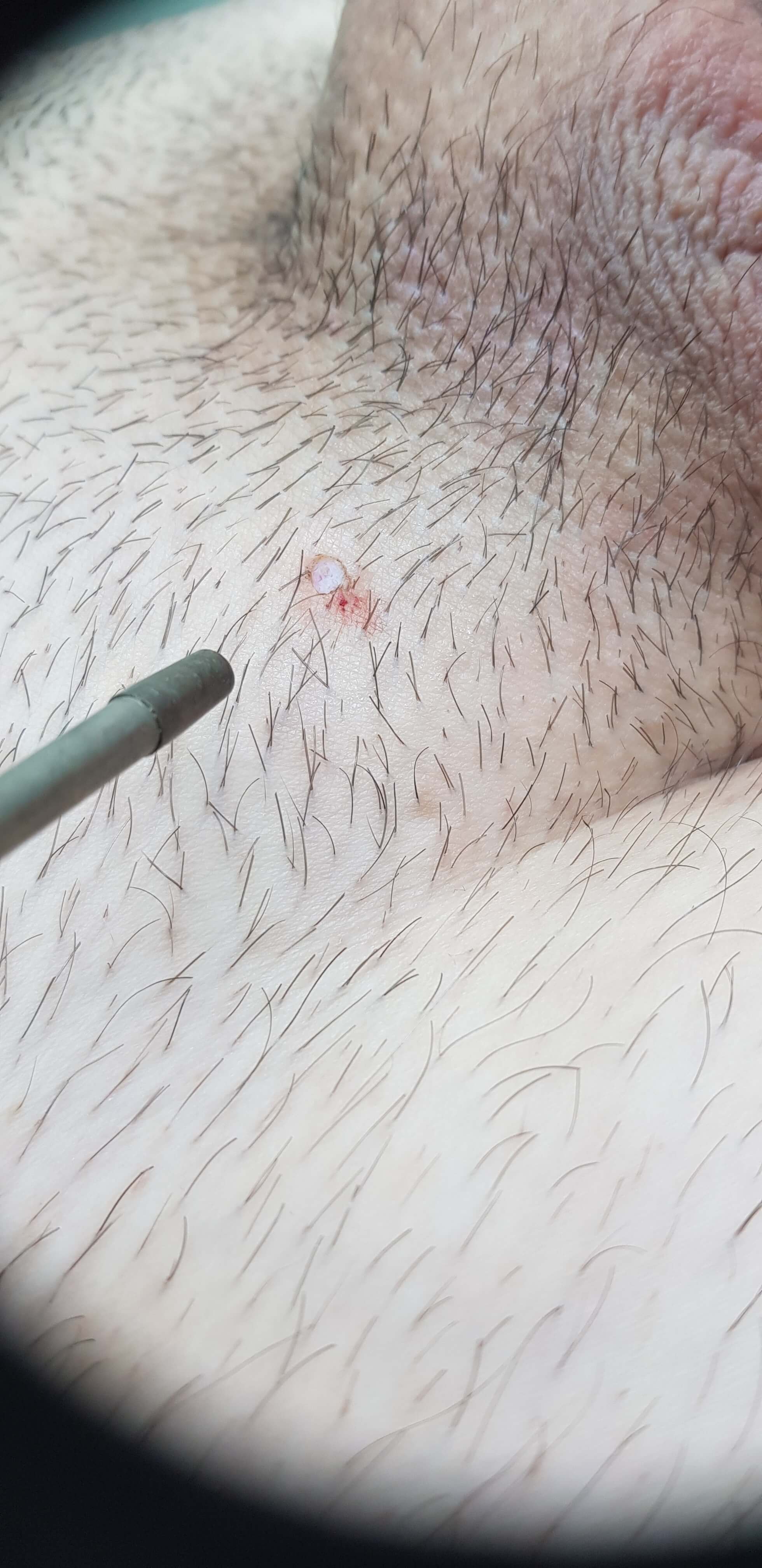 контагиозный моллюск