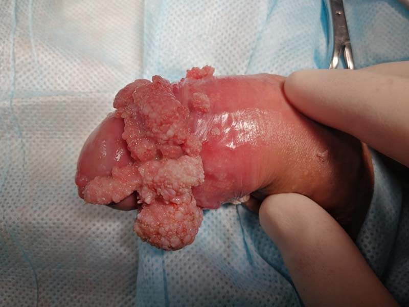 удаление патогенных образований оперативное удаление кодлилом