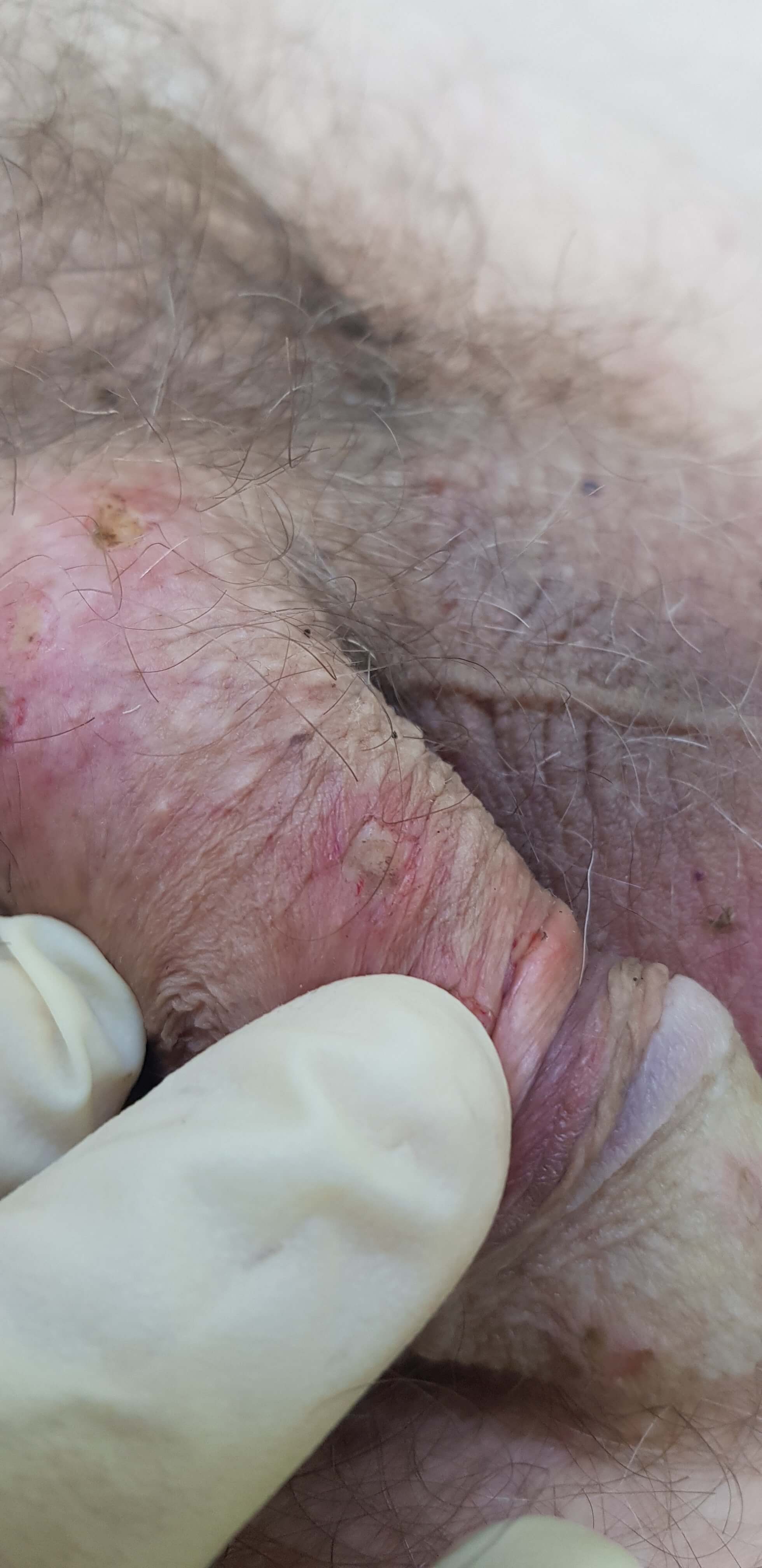 удаление кондилом