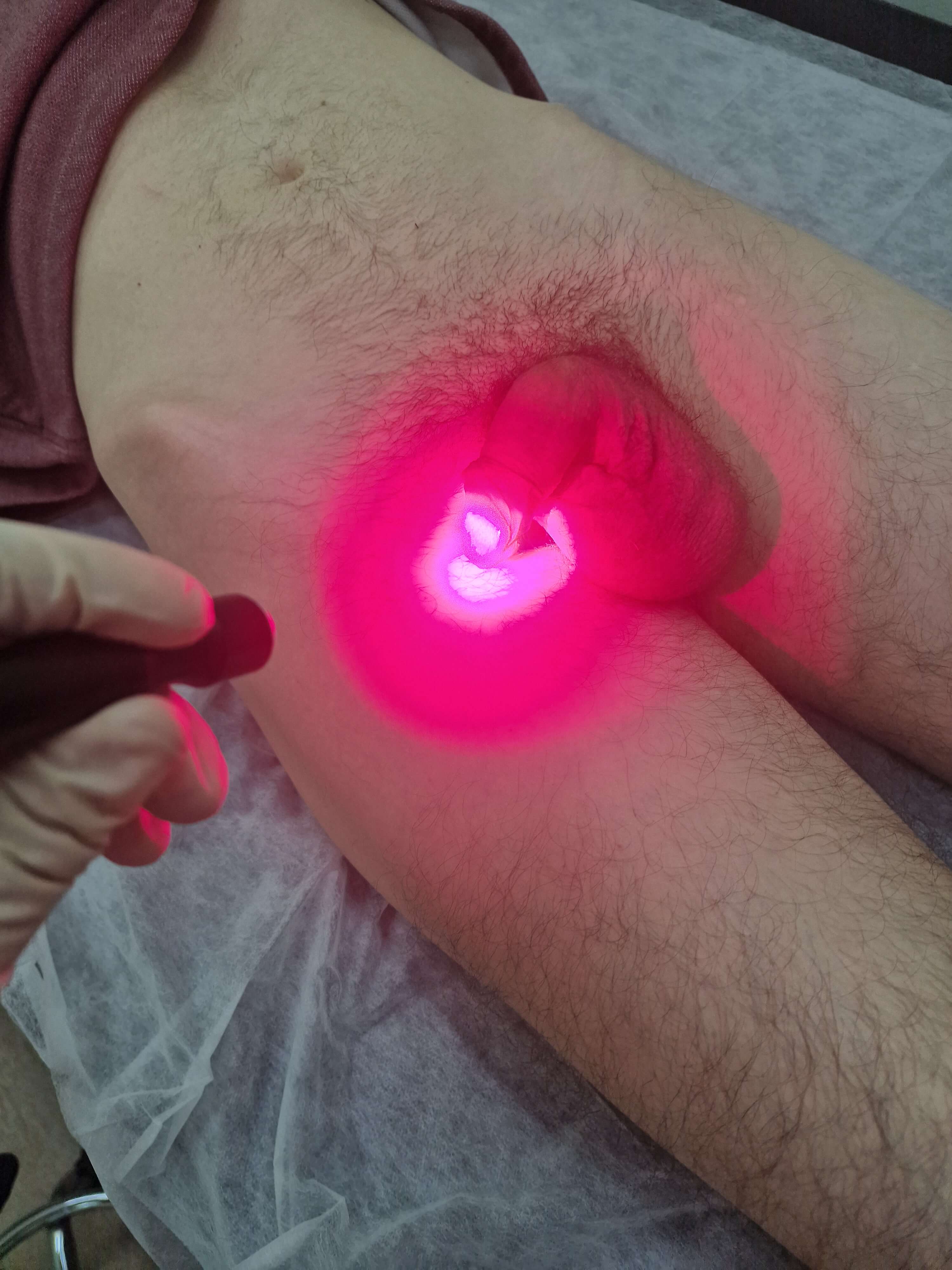 применение фотодинамического лазера после удаления