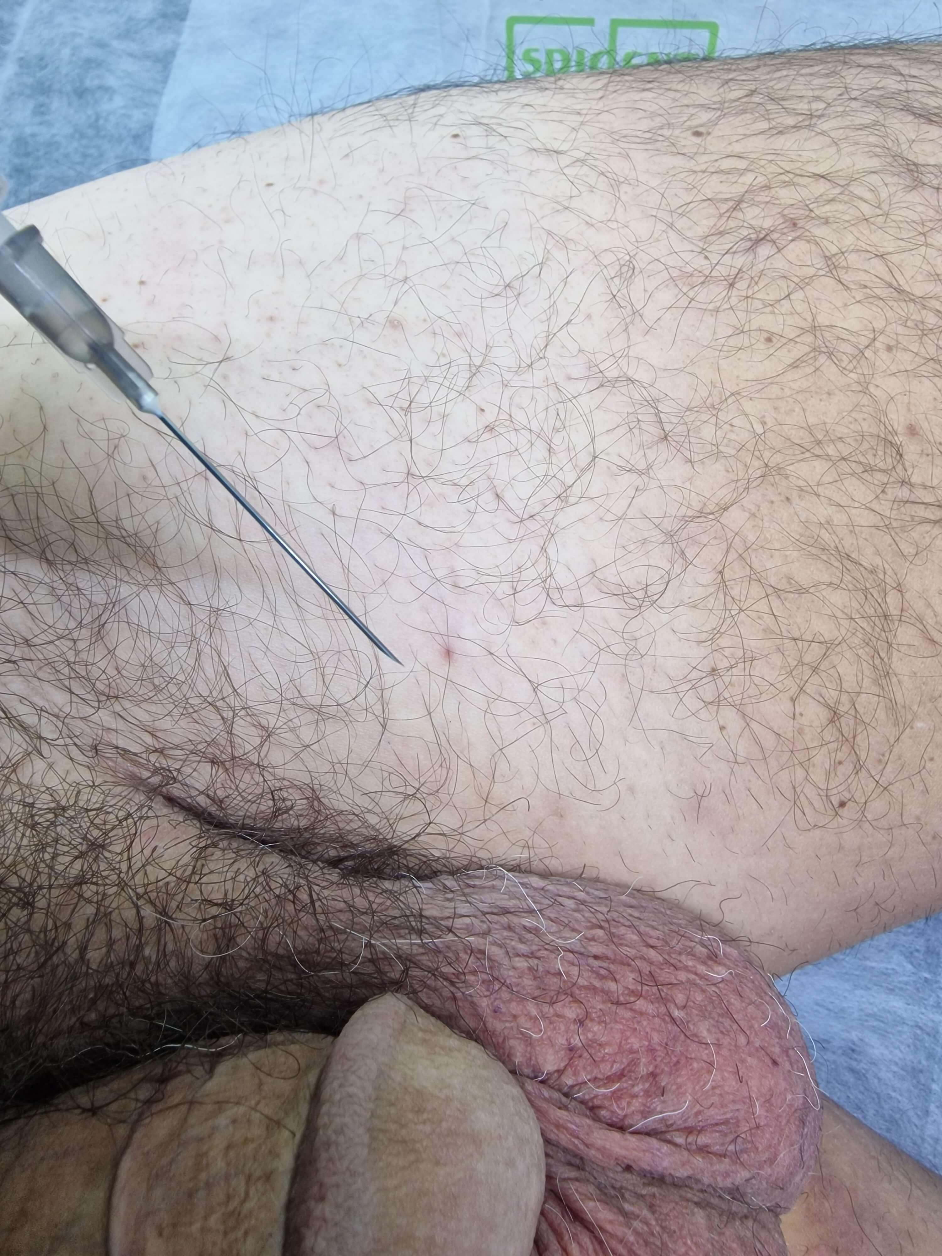 лечение отека члена лекарствами лимфортопка