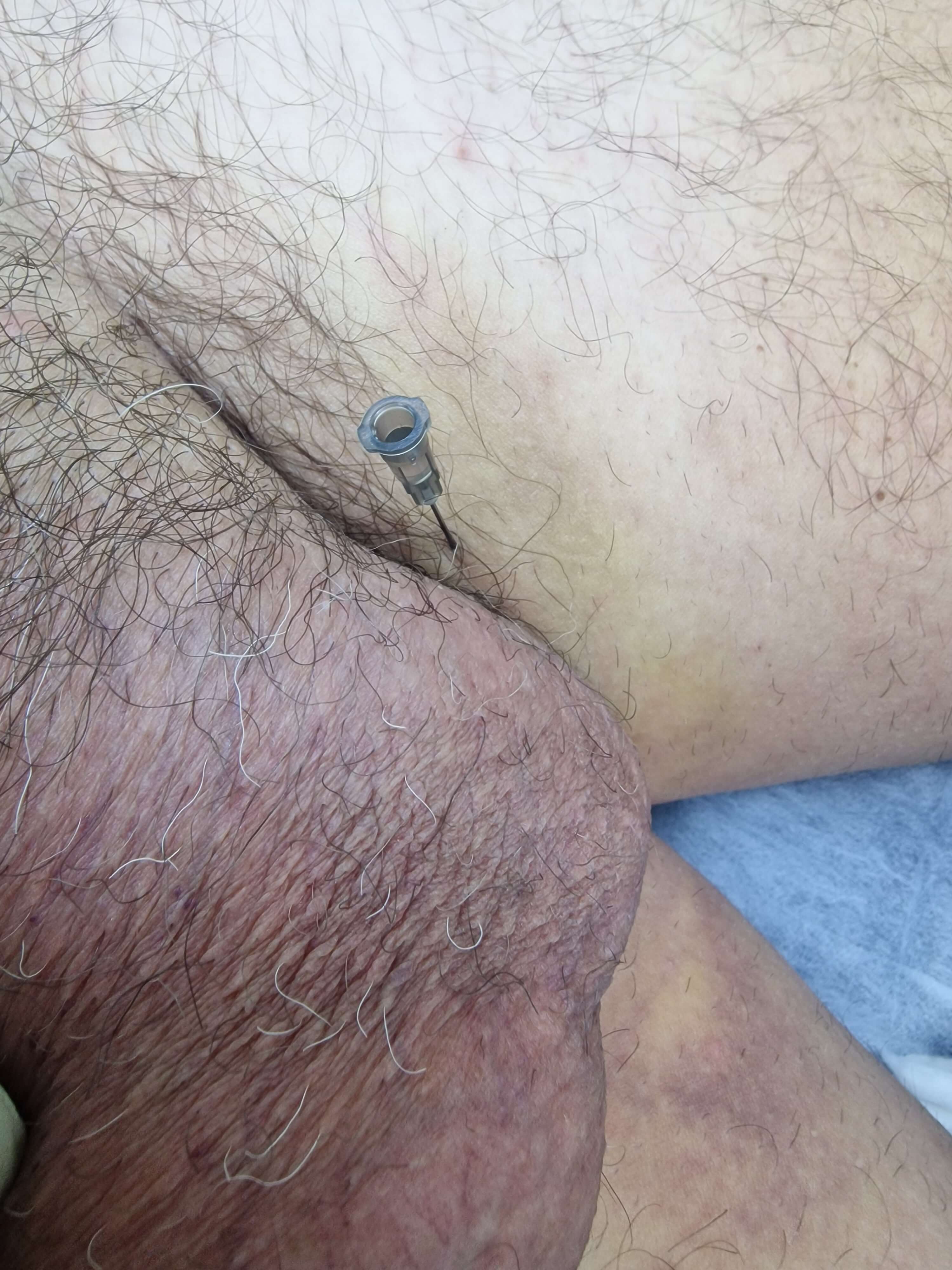 лечение препаратами Лимфотропное введение препаратов