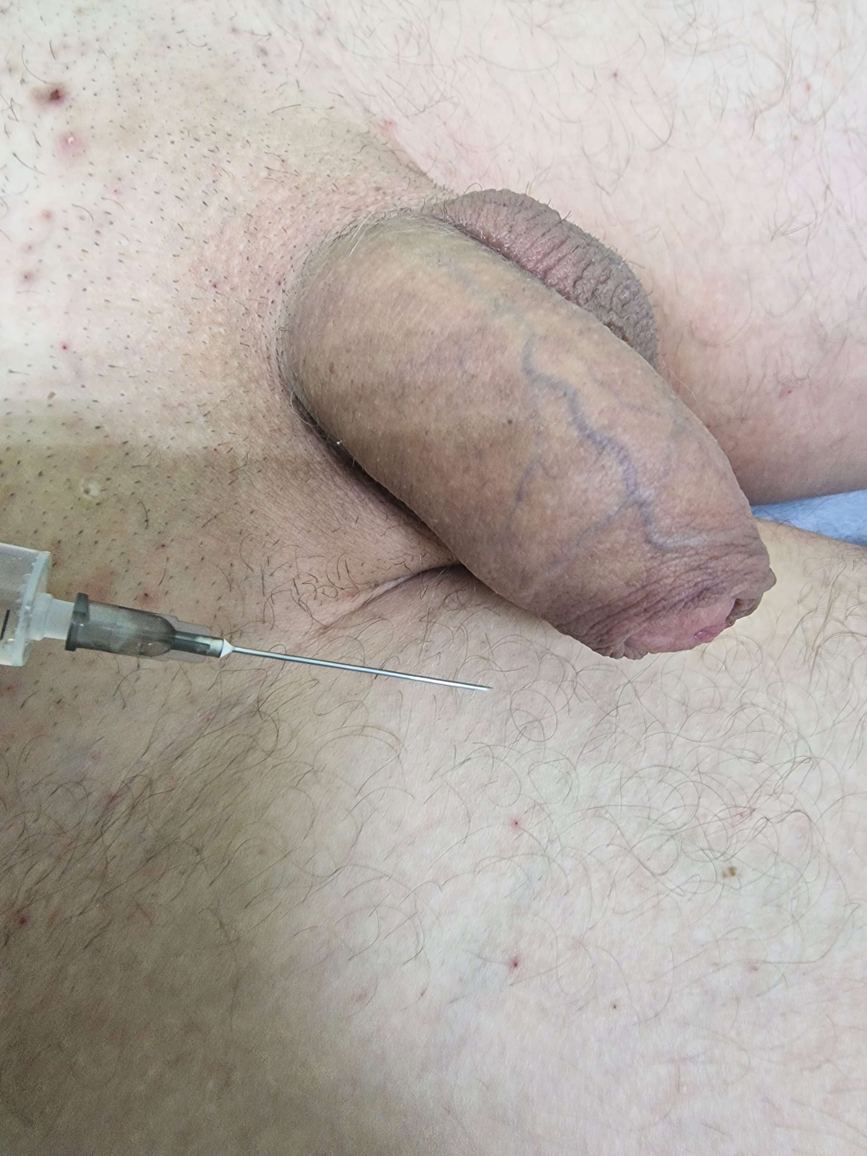 лимфотропное введение антибиотиков