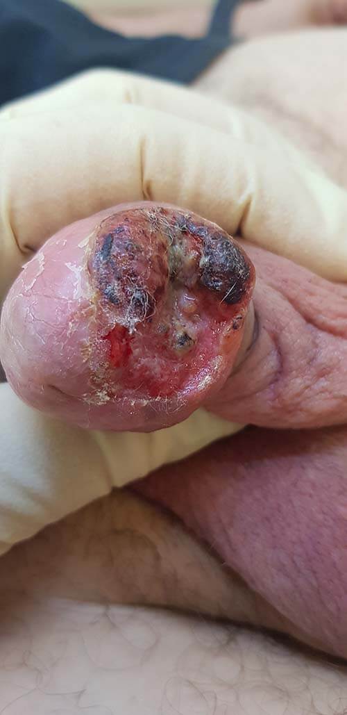 онкологическая опасность рак члена