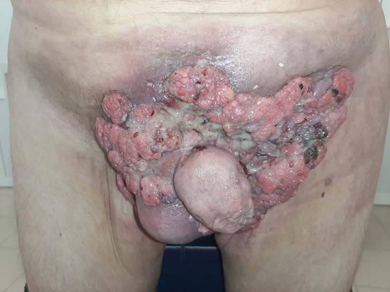 терапия патогена передача ВПЧ половым путем