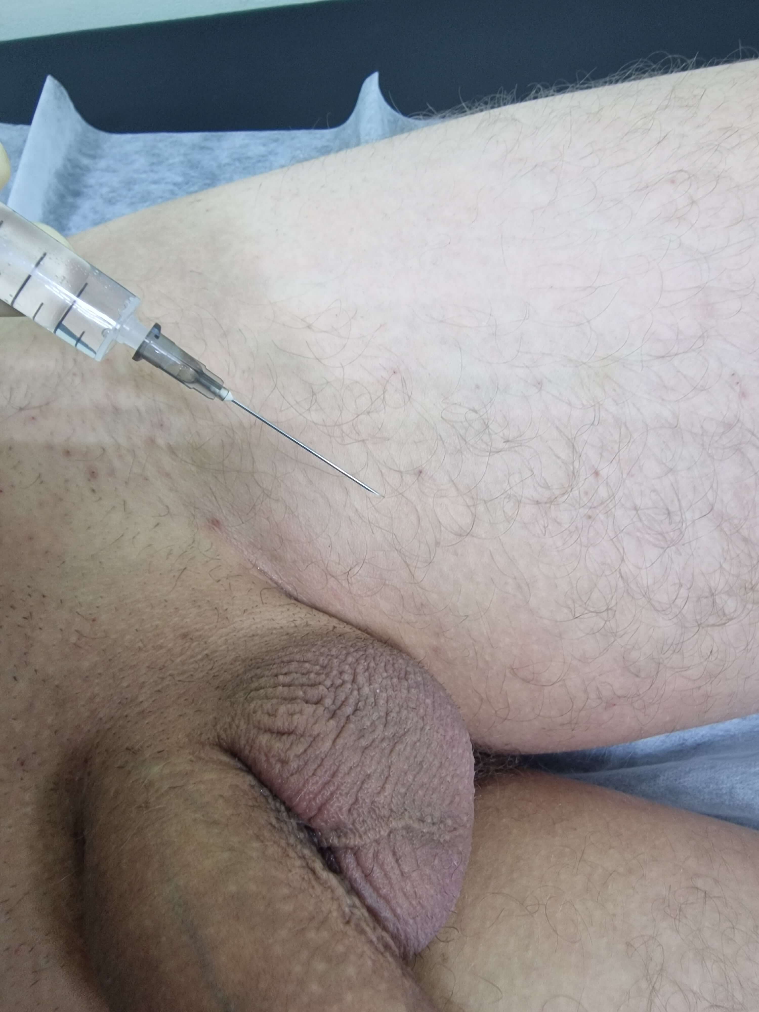 Лимфотропное введение антибиотиков