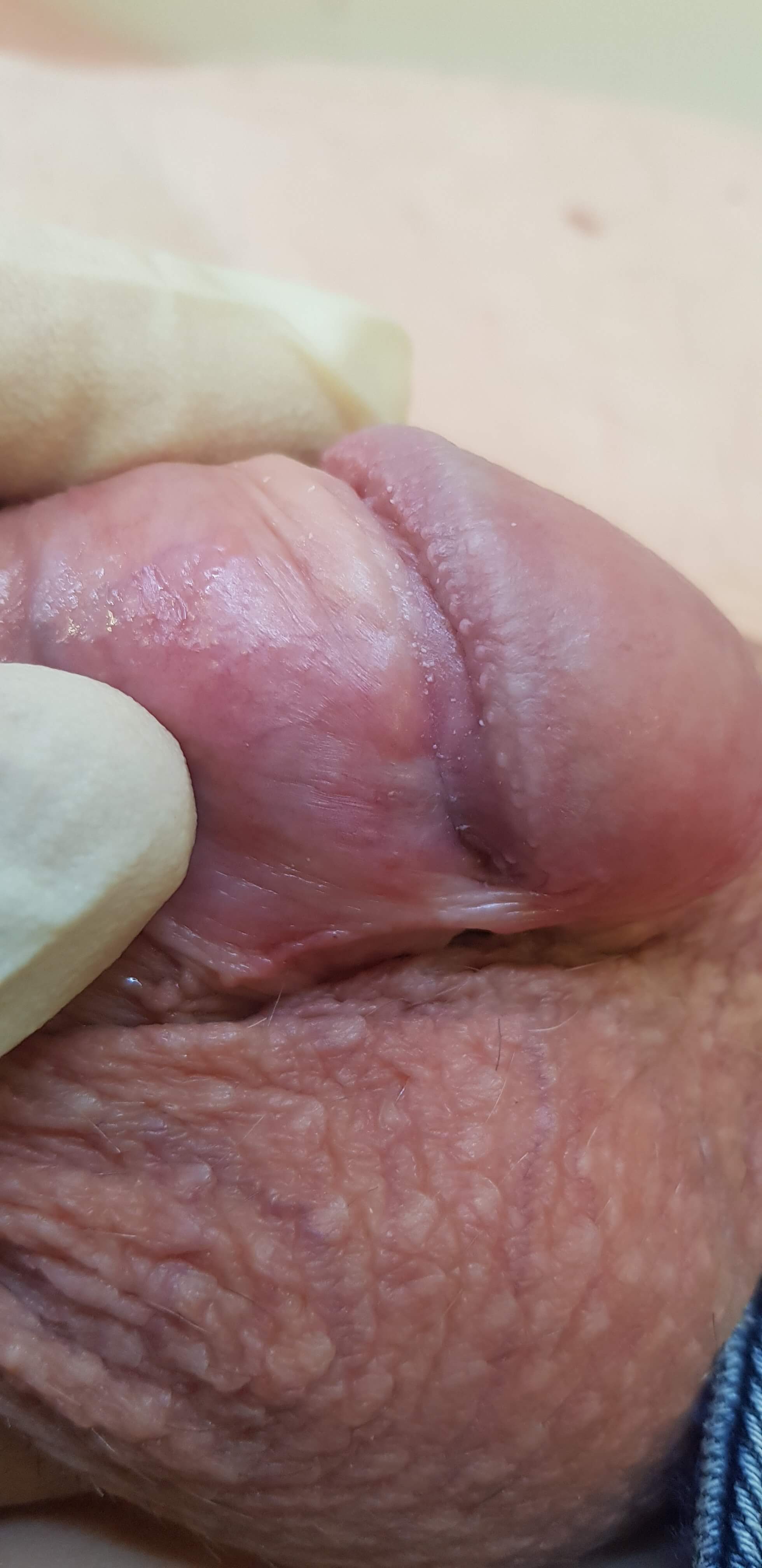 отек члена аллергия отек члена