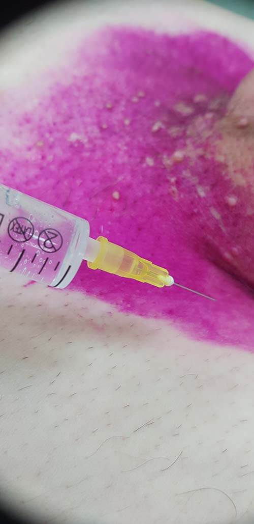 лечение препаратами Лимфотропное введение различных препаратов