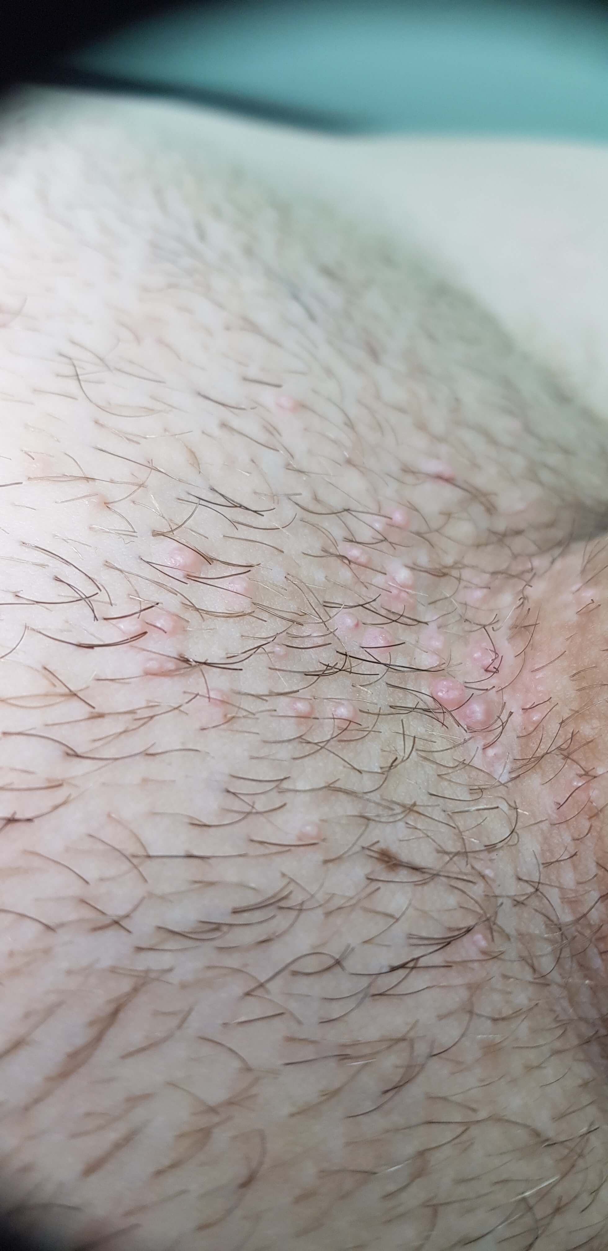 контагиозный моллюск