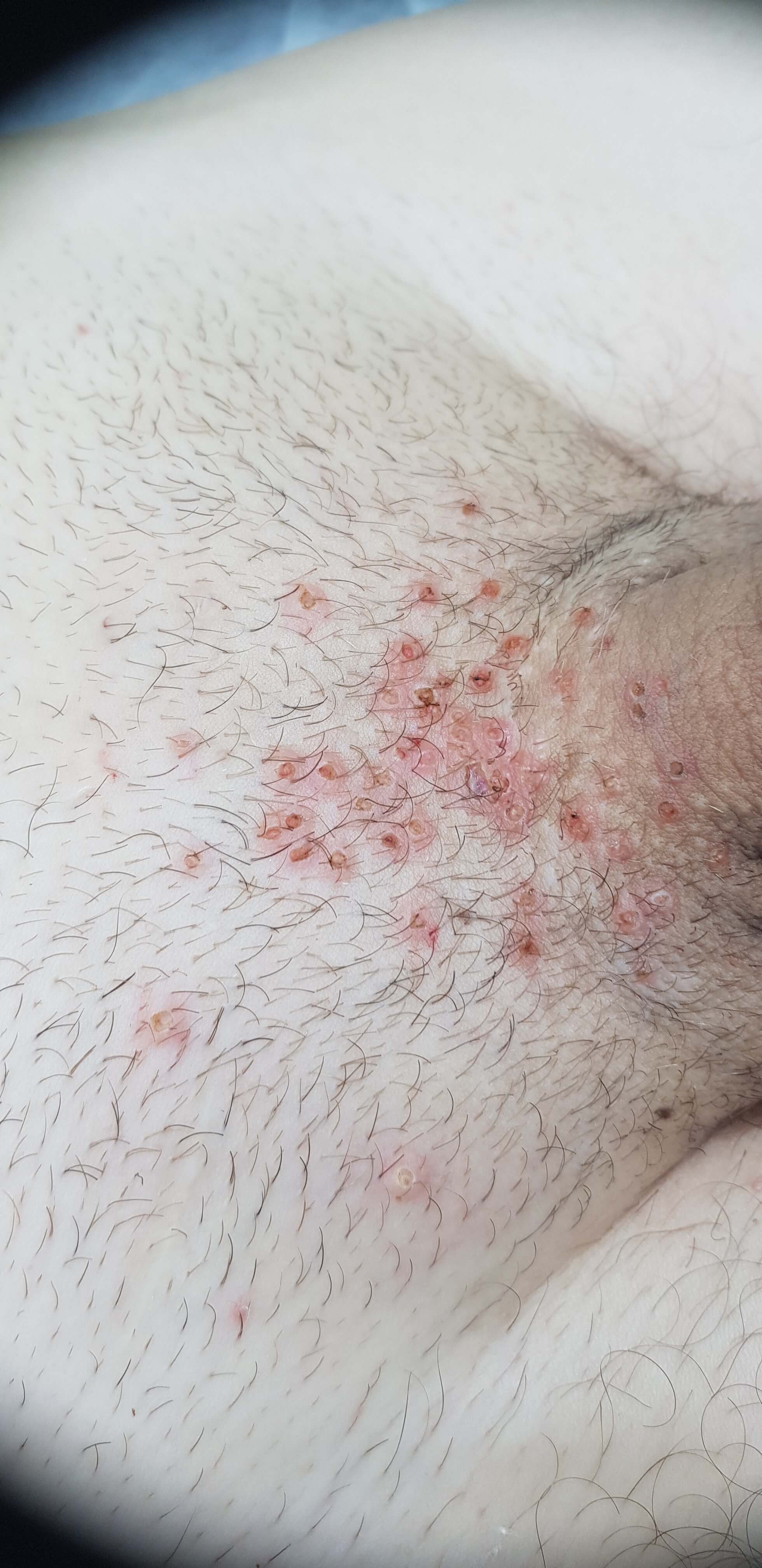 симптомы моллюска