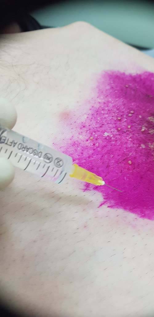 лечение препаратами лимфотропное введение