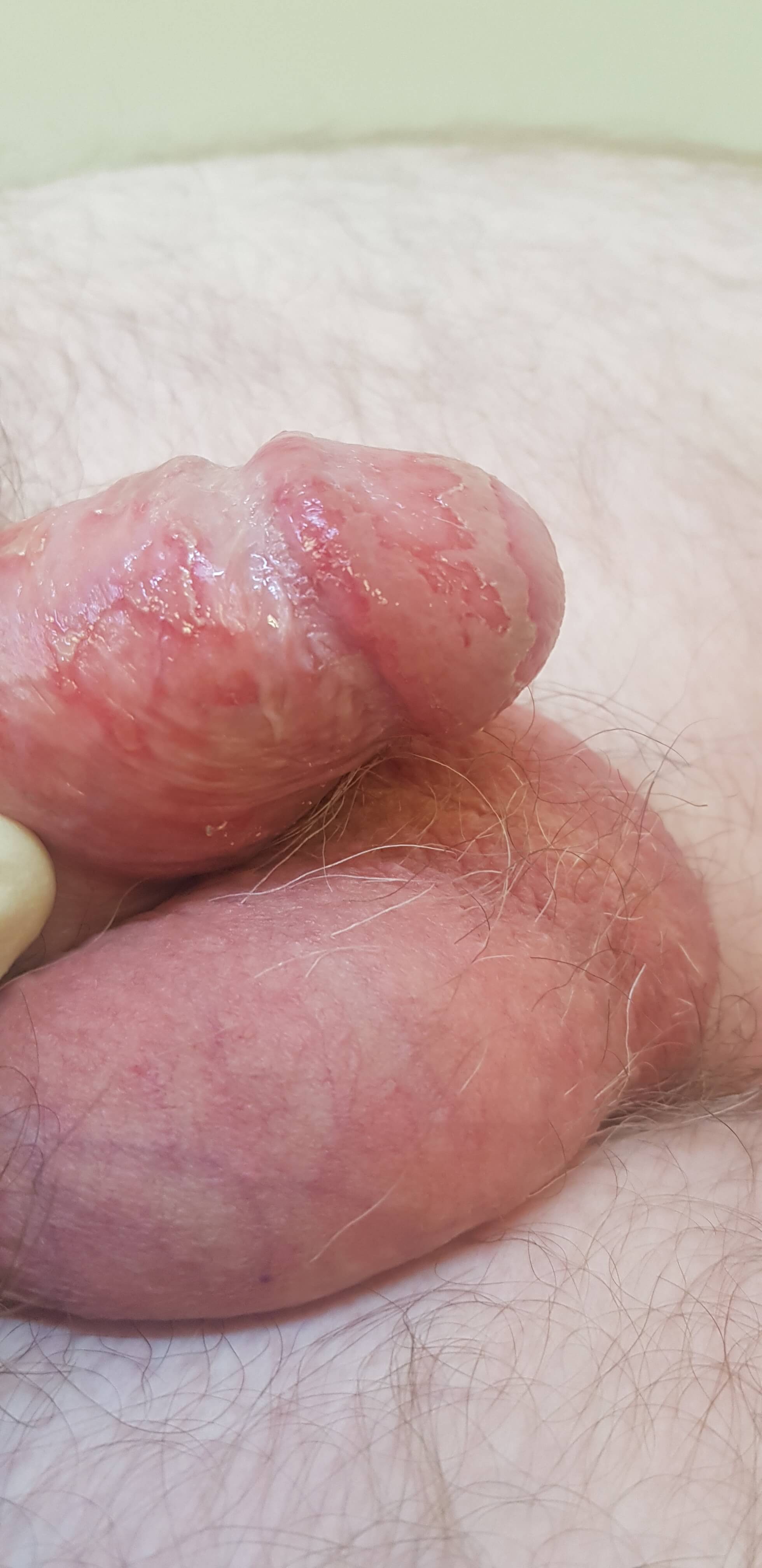 симптомы сифилиса выделения при сифилисе