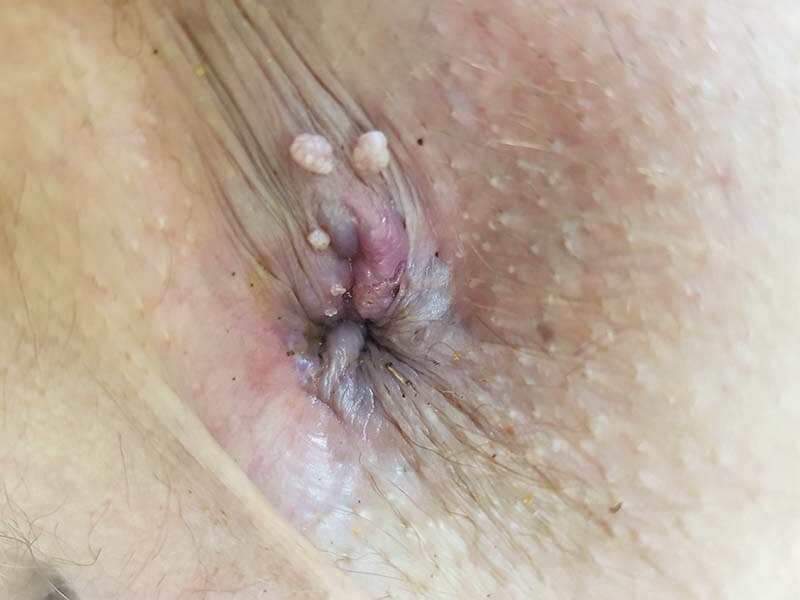 впч поражение слизистых