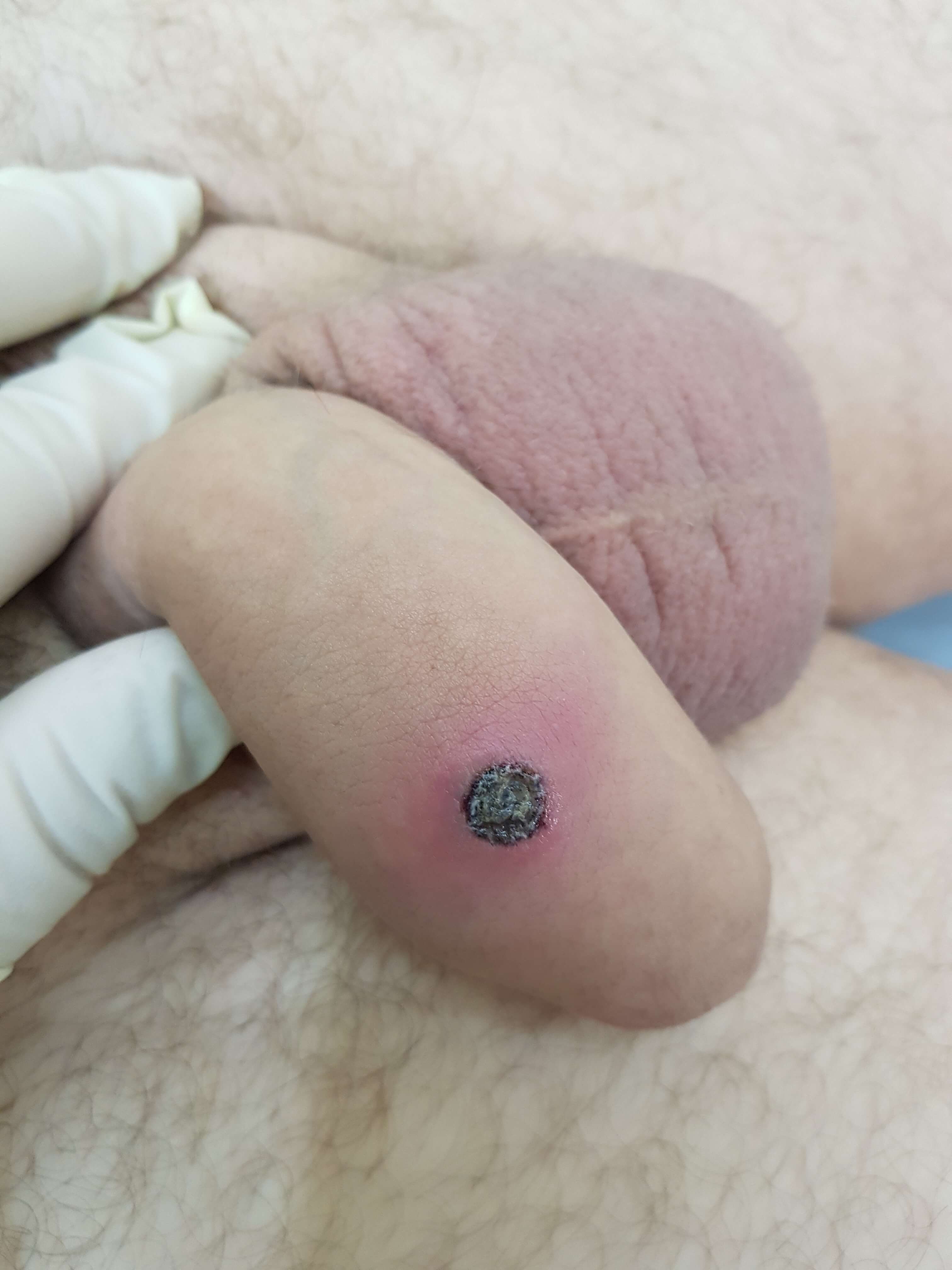 твердый шанкр