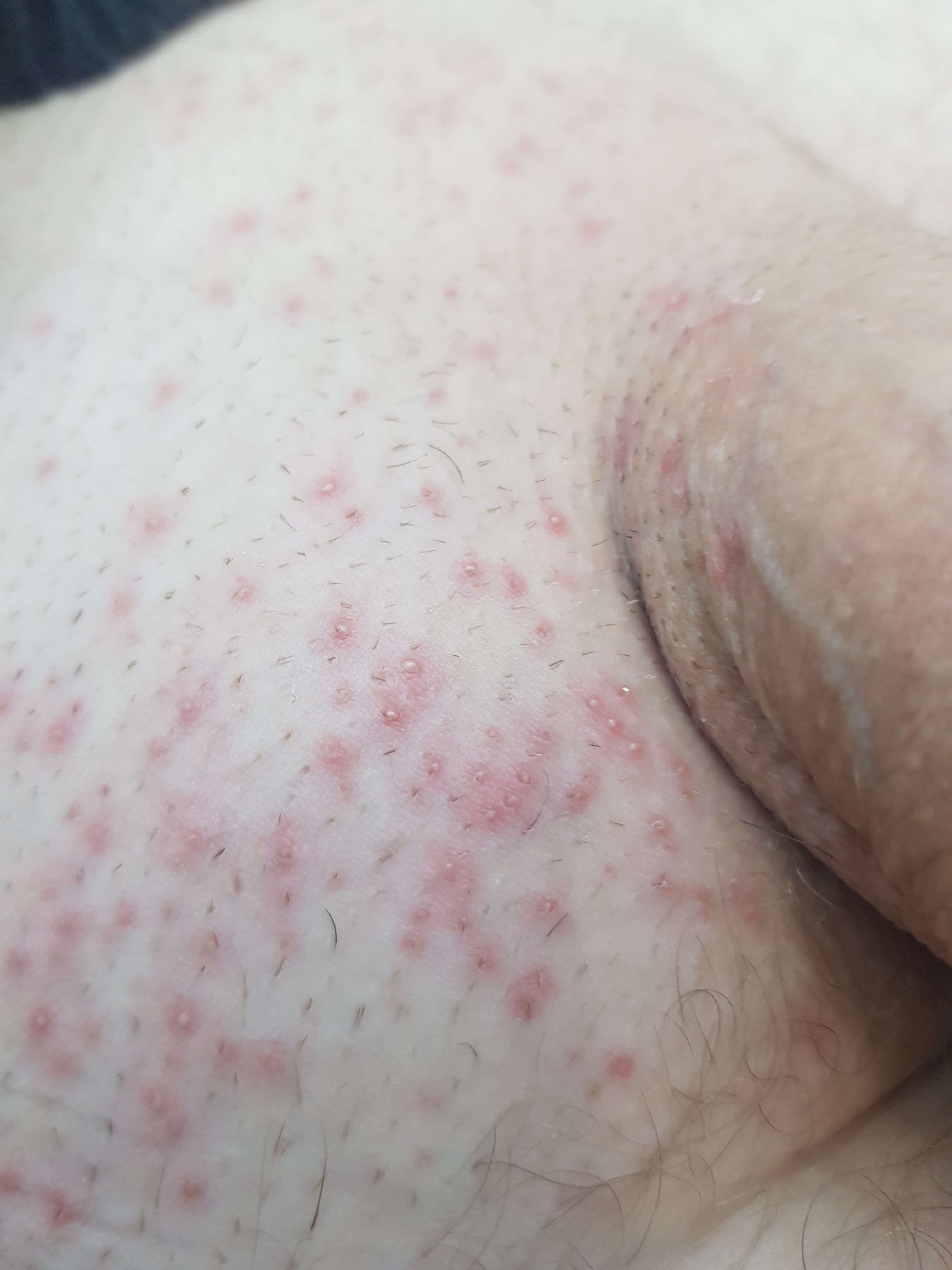 Фоликулит после бритья