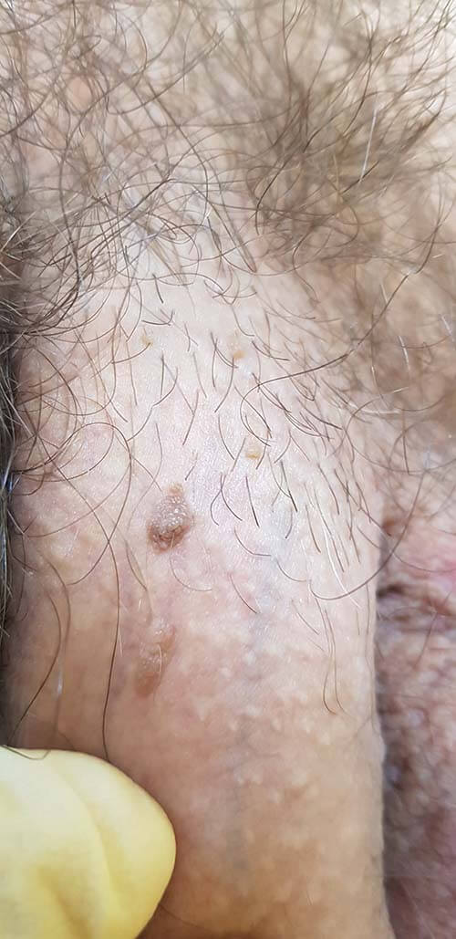 осложнение ВПЧ Бовеноидный папулез