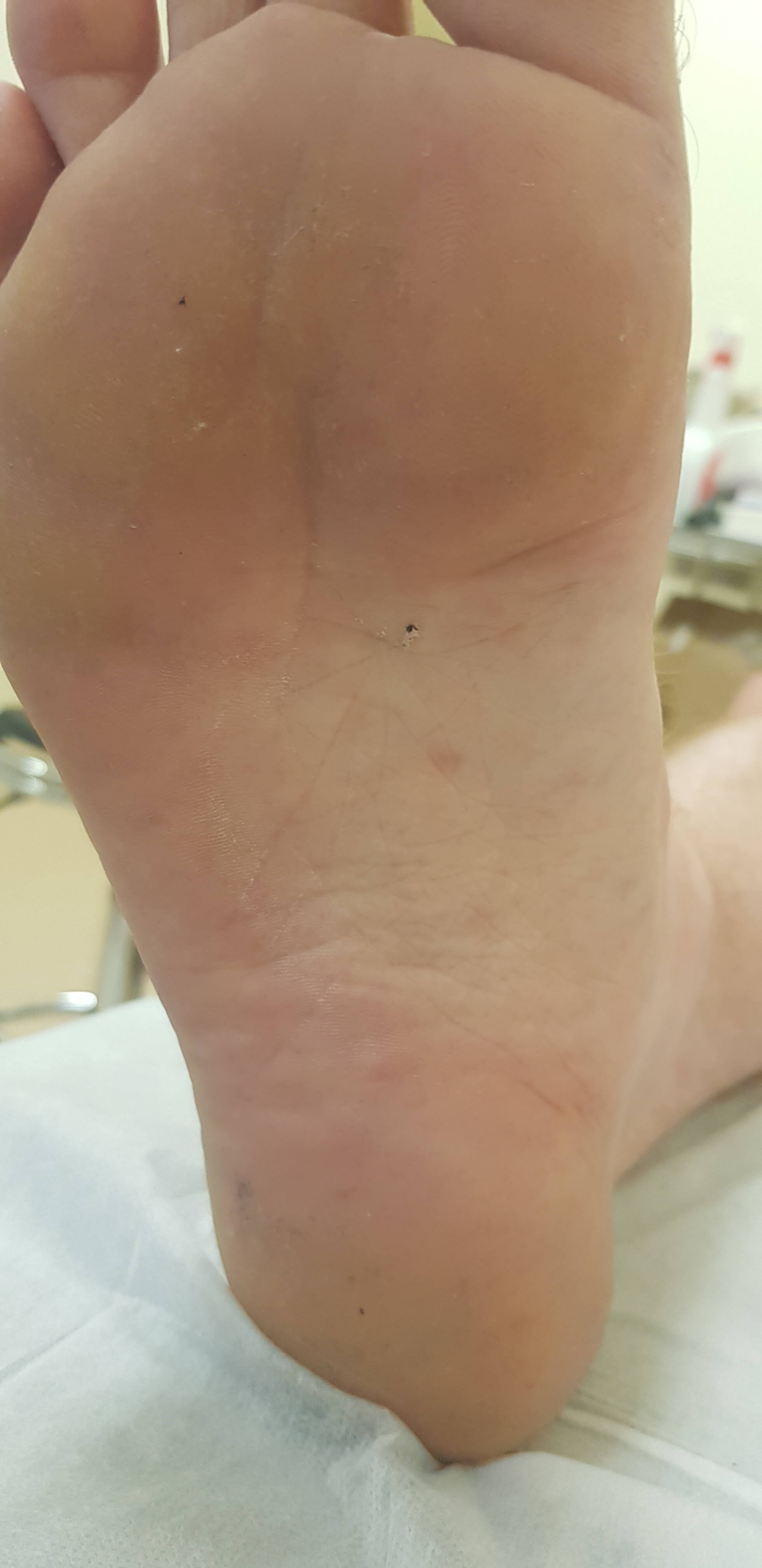 образования на стопах образования на подошвах