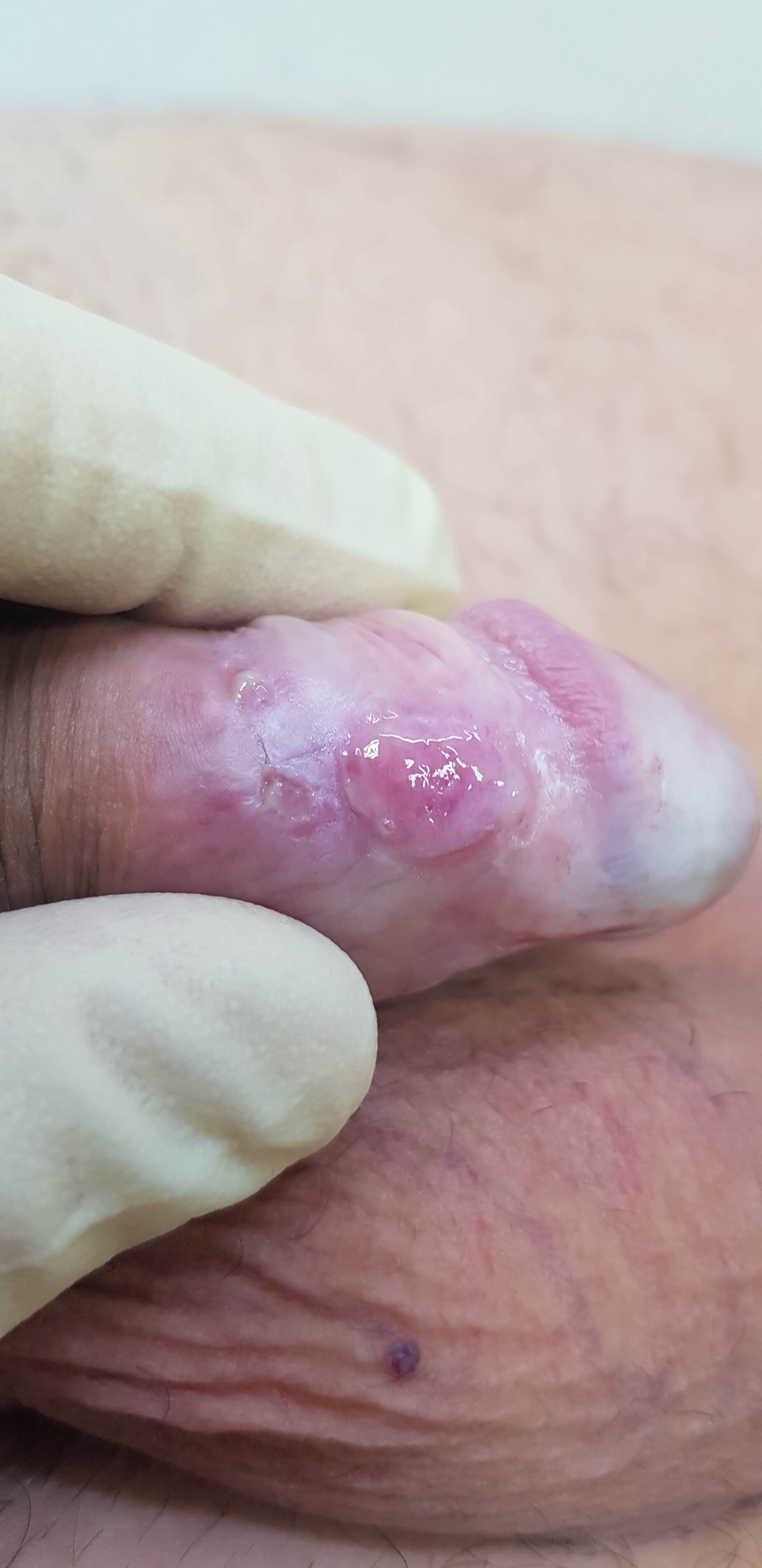 Антитела в крови