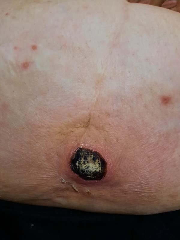 язвенная пиодермия язвы при диабете