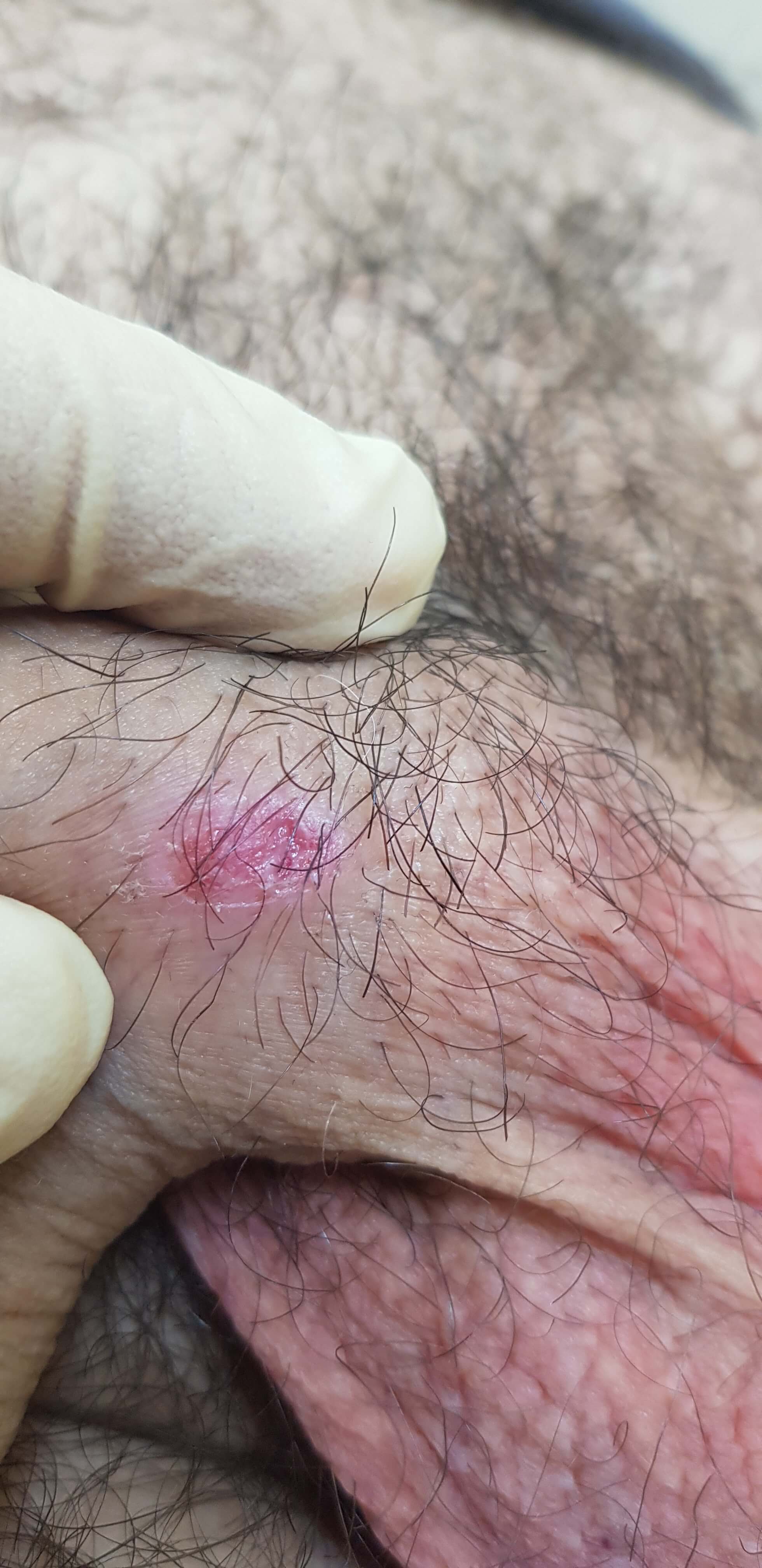 этапы сифилиса