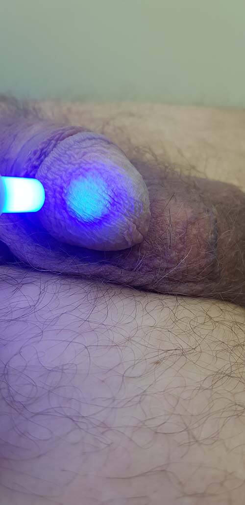 Обработка головки Обработка оксидом азота